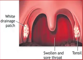  ?? ISITHOMBE: YOUTUBE.COM ?? UMPHIMBO wesiguli esihlaselw­e yi-rheumatic fever.