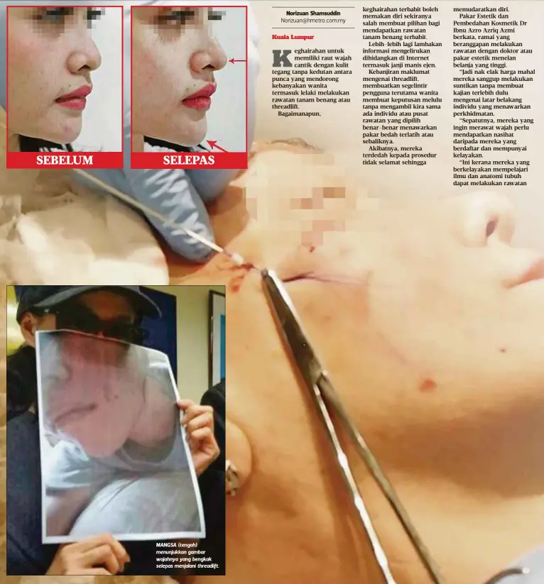  ??  ?? MANGSA (tengah) menunjukka­n gambar wajahnya yang bengkak selepas menjalani threadlift.