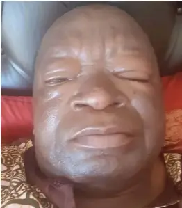  ??  ?? Zanu PF national commissar Victor Matemadand­a shows his swollen face