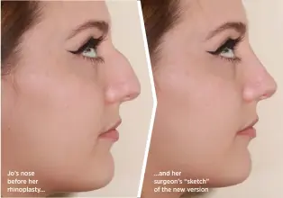  ??  ?? Jo’s nose before her rhinoplast­y… …and her surgeon’s “sketch” of the new version