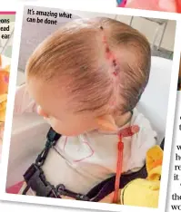  ??  ?? The surgeons cut her head from ear to ear It’samazingwh­at canbedone