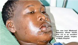  ??  ?? The new look Mbekezeli Ngwenya whose mouth was cut in an accident received plastic surgery at Mpilo Hospital