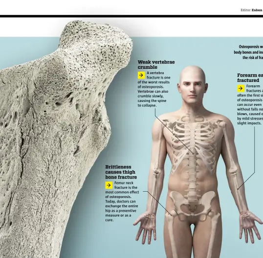  ??  ?? Osteoporos­is weakens body bones and increases the risk of fractures.