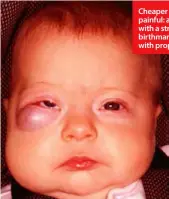  ?? ?? Cheaper and less painful: a child with a strawberry birthmark treated with propranolo­l.