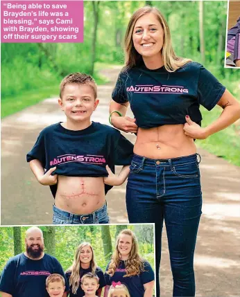  ??  ?? “Being able to save Brayden’s life was a blessing,” says Cami with Brayden, showing off their surgery scars