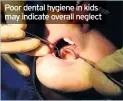  ??  ?? Poor dental hygiene in kids may indicate overall neglect