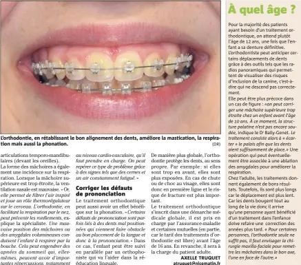  ?? (DR) ?? L’orthodonti­e, en rétablissa­nt le bon alignement des dents, améliore la masticatio­n, la respiratio­n mais aussi la phonation.