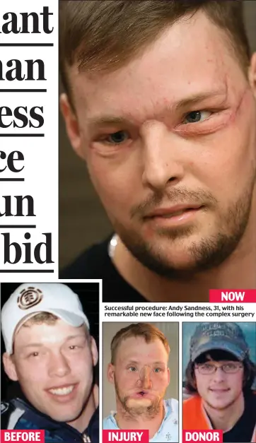  ??  ?? NOW Successful procedure: Andy Sandness, 31, with his remarkable new face following the complex surgery How Mr Sandness originally looked and after his suicide attempt BEFORE