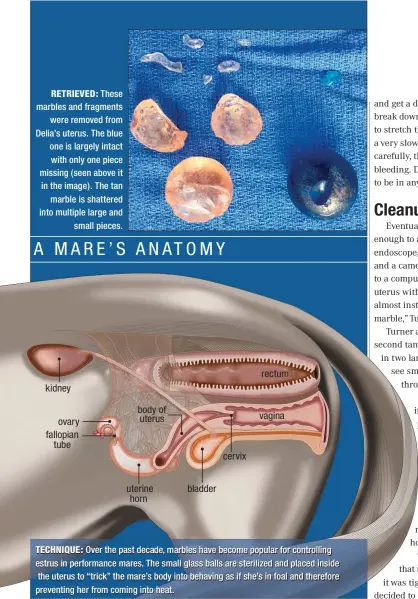  ??  ?? These marbles and fragments
were removed from Delia’s uterus. The blue one is largely intact with only one piece missing ( seen above it in the image). The tan
marble is shattered into multiple large and
small pieces.
kidney
ovary fallopian
tube...