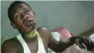  ??  ?? Jacob Viera bears the scars of the deliberate electric shock inflicted in his native Kenya that almost ended his life.