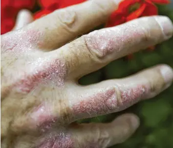  ?? Foto: Arno Burgi, dpa ?? Menschen mit Schuppenfl­echte wurden lange stigmatisi­ert. Dabei ist die Hauterkran­kung weder ansteckend noch ein Zeichen von mangelnder Hygiene.