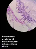  ??  ?? Postmortem evidence of invasive aspergillo­sis in lung tissue