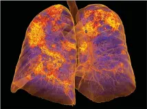  ??  ?? A CT scan of the lungs of a Covid-19 patient with pneumonia