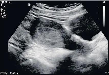  ??  ?? > An ultrasound image of endometria­l thickening