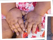  ??  ?? Her hands and feet began swelling considerab­ly six years ago. Because of their size, the former cashier is unable to perform ordinary tasks and depends on help from family.