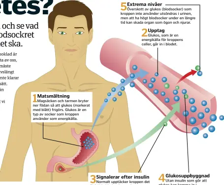  ??  ?? När bukspottkö­rteln inte producerar insulin blir glukos kvar i blodet.
4 Glukosuppb­yggnad
Utan insulin som gör att glukos kan komma in i cellerna stiger glukosnivå­erna i blodet. Detta leder till hyperglyke­mi, högt blodsocker.
5 Extrema...