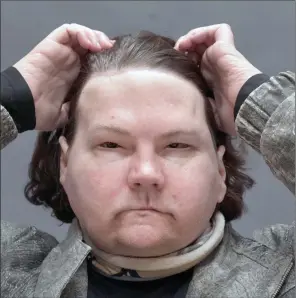  ?? The Associated Press ?? Joe DiMeo brushes back his hair while posing for a portrait at NYU Langone Health in New York, six months after an extremely rare double hand and face transplant.