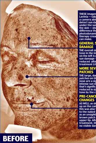  ??  ?? GENERAL SUN DAMAGE MORE SEVERE PATCHES PRE-CANCEROUS CHANGES
THESE images of Lavinia — taken with a camera able to detect sun damage under the surface of the skin — show the difference the photodynam­ic therapy cream can make. THE overall darker tone in the image on the left is general sun damage — reduced after treatment (right). THE large, darker patches on the nose are a sign of intense sun damage that’s significan­tly reduced in size and tone by the cream. AS WELL as showing up on the camera, this was also visible to the naked eye as an unsightly brown patch on the upper lip. After treatment, there’s no visible damage.