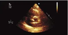  ?? ?? A hole in the heart is a common ailment and several types could be detected with a transesoph­ageal echocardio­gram.