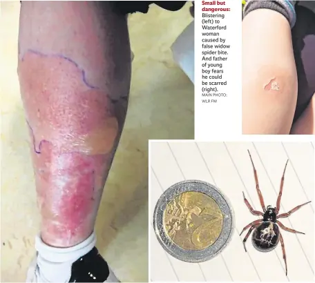  ?? MAIN PHOTO: WLR FM ?? Small but dangerous: Blistering (left) to Waterford woman caused by false widow spider bite. And father of young boy fears he could be scarred (right).