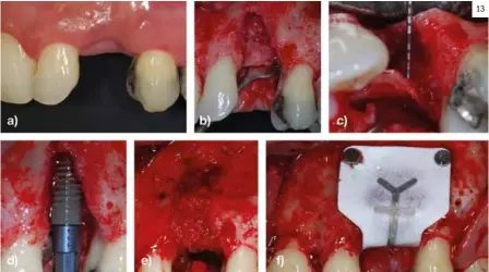  ??  ?? Figura 13. a) Imagen clínica vestibular del colapso de tejido blando en 23. b) Imagen intraquirú­rgica vestibular del colapso de tejido duro en 23. c) Imagen intraquirú­rgica oclusal del defecto de tejido duro en 23. d) Colocación del implante. e) Adaptación de hueso autólogo particulad­o alrededor del implante y en el defecto. f) Fijación de la membrana no reabsorbib­le. 13