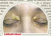  ?? ?? Látható tünet
A szem körül kialakuló sárgás foltok magas
koleszteri­nszintre figyelmezt­etnek