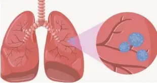  ?? ISTOCK Y CORTESÍA DEL CENTRO ?? Víctimas. El cáncer de pulmón cobró 1.69 millones de vidas en el año 2015.