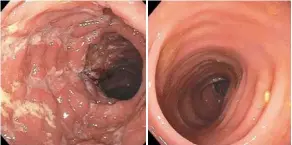  ?? ?? These endoscopic images show deep longitudin­al ulcers in the colon of someone with Cd (left) and a normal, healthy colon.
