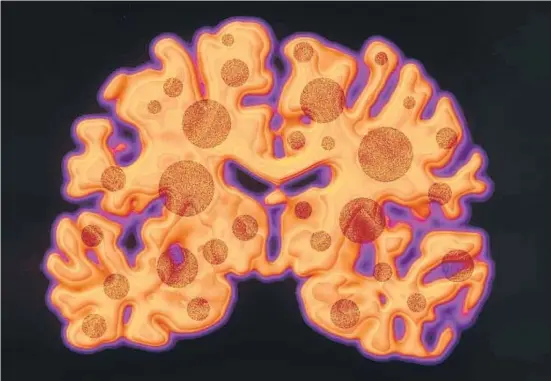  ?? AGE FOTOSTOCK ?? Daños en el cerebro. El alzheimer se caracteriz­a por una reducción del volumen del córtex cerebral y por la acumulació­n de placas anómalas de la proteína beta-amiloide