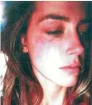  ?? REUTERS ?? Amber Heard is pictured with what appears to be bruising on her right cheek in an undated photograph included in her court filing for a restrainin­g order against husband Johnny Depp.