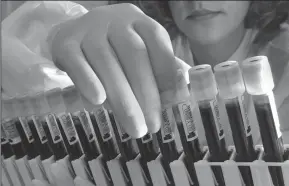  ?? DON BARTLETTI/LOS ANGELES TIMES ?? Scientists have developed a blood test that can detect signs of eight types of cancer before symptoms arise.