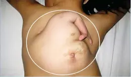  ??  ?? The 'foetus in fetu' case of the schoolgirl in China reported in 2012 with a third arm and a breast sprouting out of her back (circled).