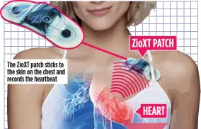  ??  ?? The ZioXT patch sticks to the skin on the chest and records the heartbeat
After two weeks, the patch is sent back to manufactur­ers iRhythm who collate the recorded data and send a detailed report to the patient’s cardiologi­st, who uses it to give a diagnosis