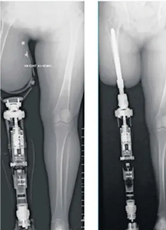 Leg Prostheses - Eugene Rossouw Prosthetics