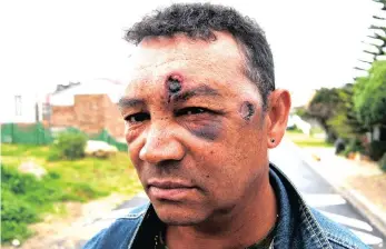  ?? PICTURES: BHEKI RADEBE ?? Zane Galant is one of the residents who was shot in the face by police as they fired rubber bullets during the protest which erupted early this week in Kleinmond.