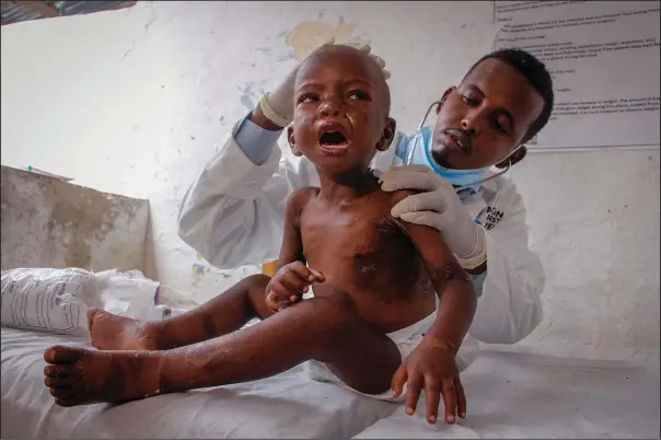  ?? (Ap/farah Abdi Warsameh) ?? Dr. Mustaf Yusuf treats Ali Osman, 3, who is showing symptoms of kwashiorko­r, a severe protein malnutriti­on causing swelling and skin lesions, on June 5 at a malnutriti­on stabilizat­ion center run by Action against Hunger in Mogadishu, Somalia.