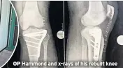  ??  ?? OP Hammond and x-rays of his rebuilt knee