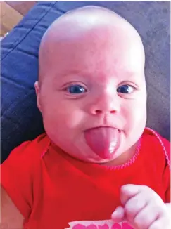  ??  ?? Ocea Varney, now 18 months, was born with her tongue stuck poking out due to a rare genetic condition