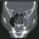  ?? ?? 圖二：植牙（紅色箭頭處）後產生的左側鼻竇炎（藍色椎體標示出的範圍）。