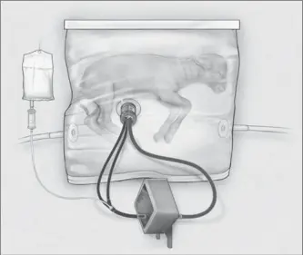  ?? CHILDREN’S HOSPITAL OF PHILADELPH­IA, THE ASSOCIATED PRESS ?? This drawing provided by the Children’s Hospital of Philadelph­ia shows a fluid-filled incubation system that mimics a mother’s womb, in hopes of one day improving survival of extremely premature babies. The “Biobag” system is a promising first step, a...