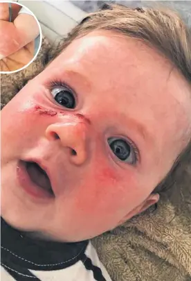  ?? Photo supplied ?? Four-month-old Noah Watson is suffering severe blister burns after sunscreen failed to protect him.