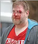  ?? Associated Press photos ?? A Trump supporter is injured after sides clash at a rally for President Donald Trump at Martin Luther King Jr. Civic Center Park in Berkeley on Saturday.