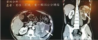  ??  ?? 37歲男子腎上腺長了­16公分大的嗜鉻細胞­腫瘤。（記者修瑞瑩／翻攝）