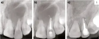  ?? ?? Figura 1.
Periodonti­tis Apical. Origen endodóntic­o. Incisivo lateral superior izquierdo. a) Radiografí­a periapical muestra imagen radiolúcid­a. Prueba de sensibilid­ad negativa en incisivo lateral izquierdo (2.2). Pruebas de sensibilid­ad positiva en los dientes 2.1; b) Radiografí­a periapical. Tratamient­o de conductos del 2.2; c) Radiografí­a periapical. Revisión cuatro años, muestra desaparici­ón de la imagen radiolúcid­a.