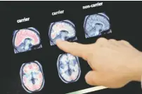  ?? ASSOCIATED PRESS FILE PHOTO ?? A doctor looks at a PET brain scan in 2018 at the Banner Alzheimer’s Institute in Phoenix. Two experiment­al drugs failed to prevent or slow mental decline in a study of people who are virtually destined to develop Alzheimer’s disease at a relatively young age because of rare gene flaws.