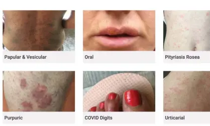  ??  ?? A screengrab from British Associatio­n of Dermatolog­ists’ website. Photograph: BAD