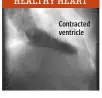  ??  ?? Contracted ventricle HEALTHY HEART
The heart ventricles normally contract completely, as they pump blood into the body.