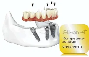  ?? Foto: Nobel Biocare ?? Die Praxiszahn­klinik Günzburg ist seit dem 1. August 2016 zeritifizi­ertes Allon4® Kompetenzz­entrum.