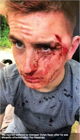  ??  ?? The injuries suffered by teenager Dylan Swan after he was allegedly attacked after the Hoppings