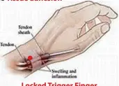  ??  ?? Locked Trigger Finger